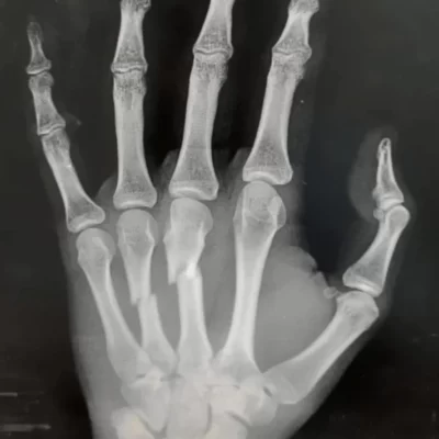 Fraturas nas Mãos