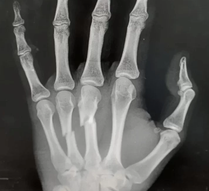 Fraturas nas Mãos
