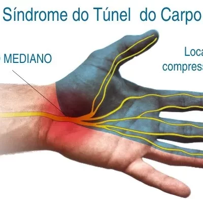 Síndrome do Túnel do Carpo
