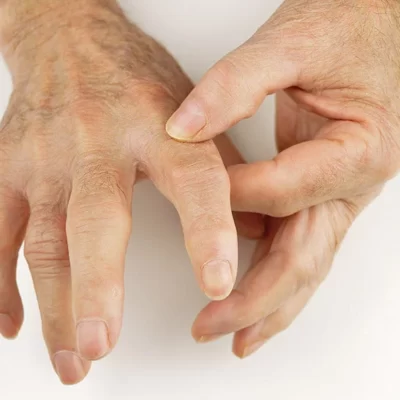 Artrose nas Mãos