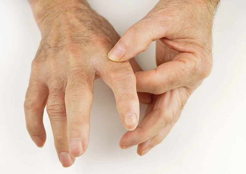 Artrose nas Mãos