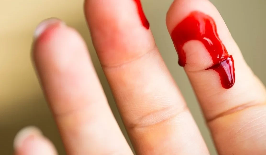 Cortes nas Mãos - Lesão de tendões ou nervos