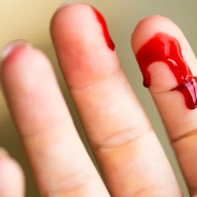 Cortes nas Mãos - Lesão de tendões ou nervos