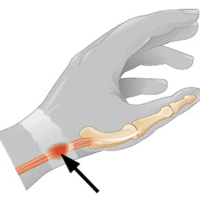 Tendinite DeQuervain - Tendinite do Polegar - Tendinite do Celular