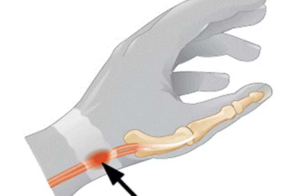 Tendinite DeQuervain - Tendinite do Polegar - Tendinite do Celular