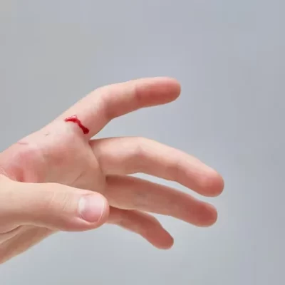 Cortes nas Mãos - Lesão de tendões ou nervos