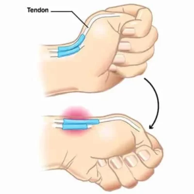 Tendinite DeQuervain - Tendinite do Polegar - Tendinite do Celular